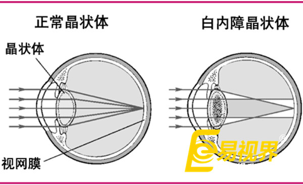 春節(jié)過量飲酒最傷眼 易視界