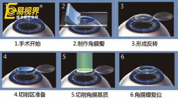 近視眼手術(shù)并非人人適宜