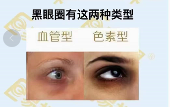 黑眼圈的兩種類型