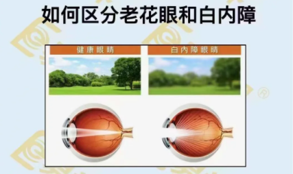 如何區(qū)分老花眼和白內(nèi)障？